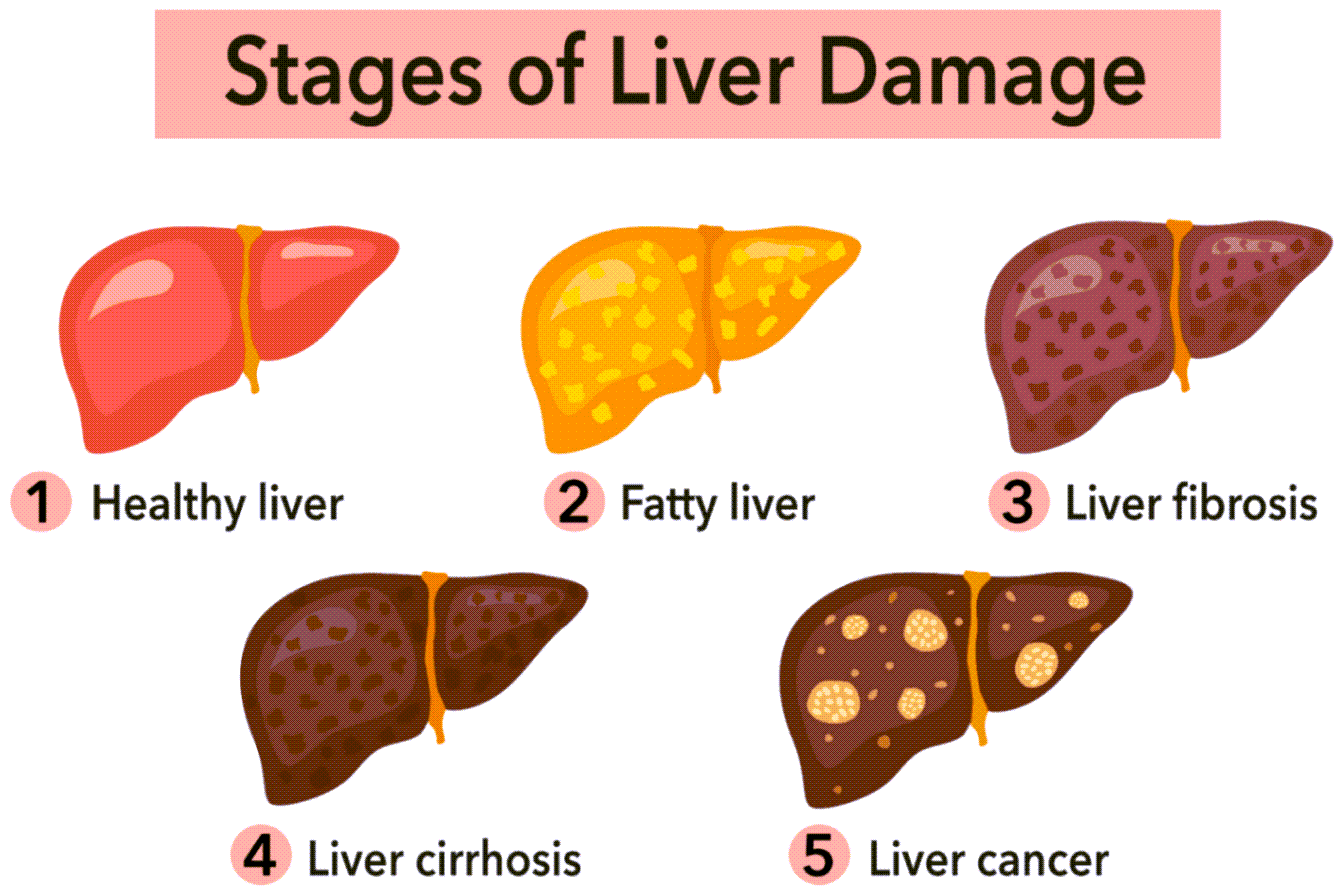 Stages of Fatty Liver