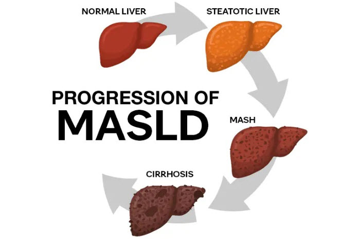 MASLD / NAFLD / MAFLD Progression