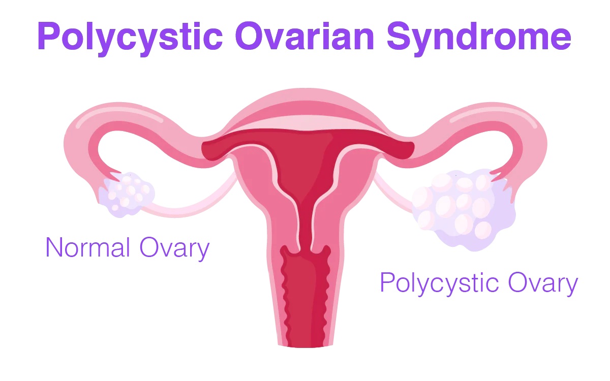 PCOS