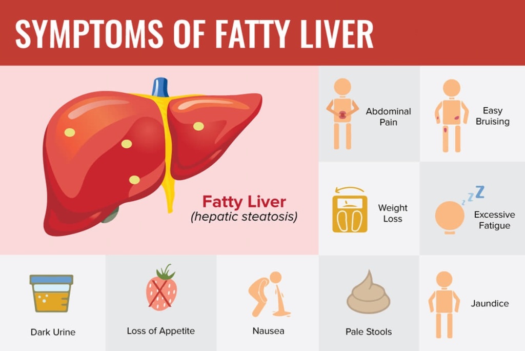 Fatty Liver Symptoms